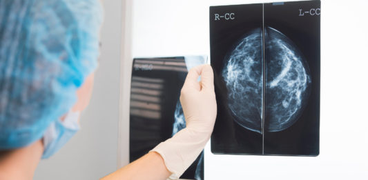 terapia innovadora, Trastuzumab deruxtecán, cáncer de mama, radiografía, pecho