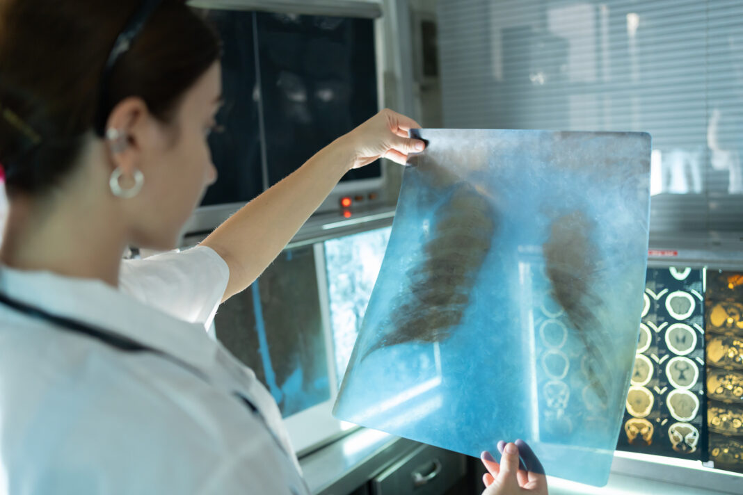 Imagen de archivo de una radiografía de pulmón